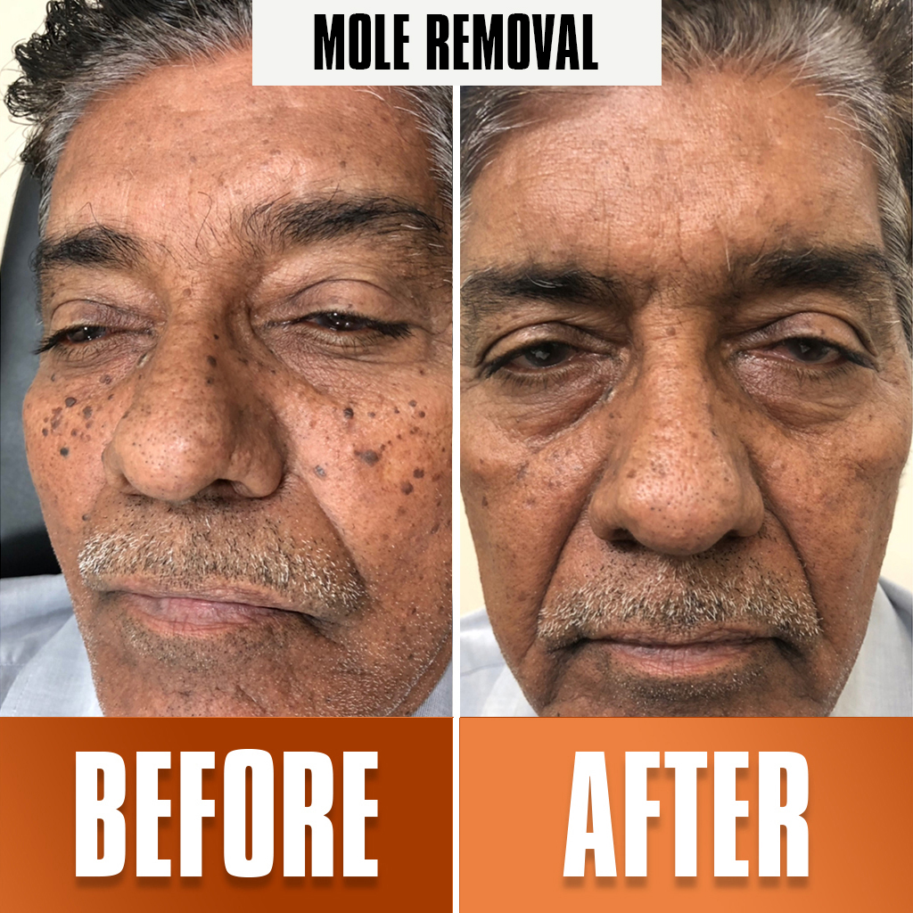 Mole-Removal