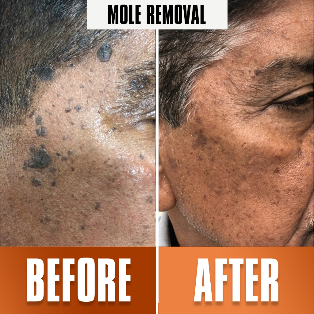 Mole-Removal