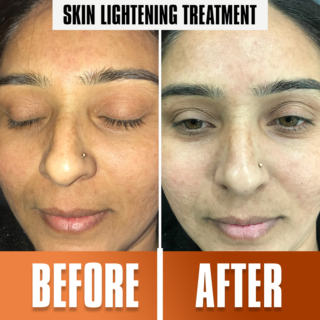 skin_lightening_treatment1